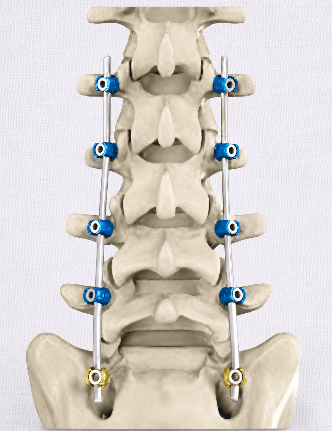 Reg Pedicle Screw System thumbnail 2